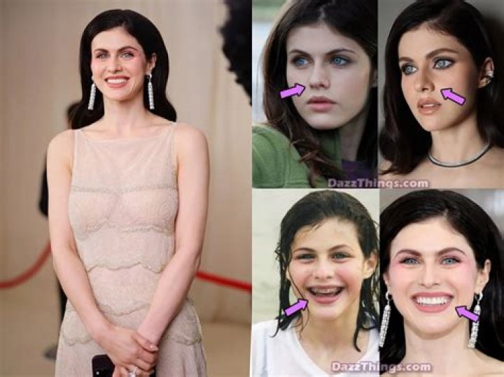 Alexandra Daddario Plastic Surgery – Botox And Lip Filler, Before And After Photos