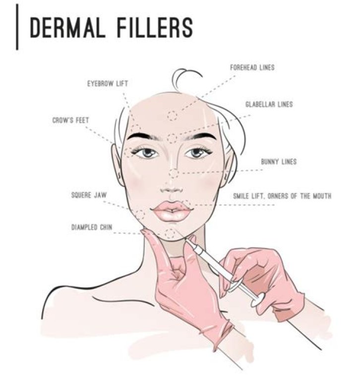Are dermal fillers permanent?