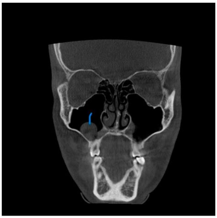 Are maxillary sinus cysts common?