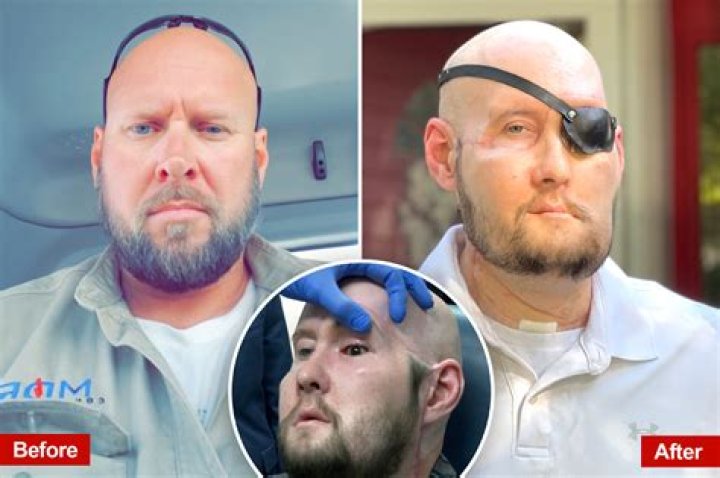 ‘Before and After’ Mitch Hunter Full Face Transplant After An Accident