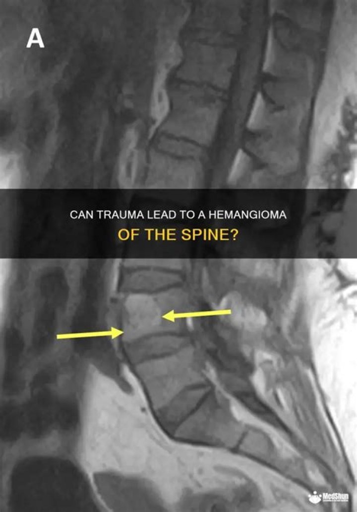 Can a hemangioma of the spine be caused by trauma?