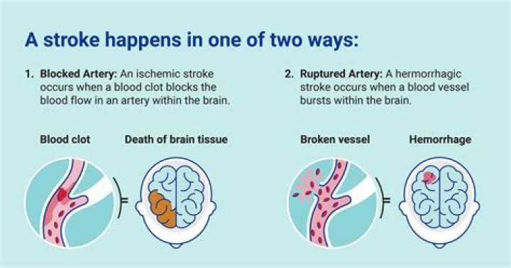 Can a stroke happen gradually?