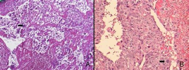 Can choriocarcinoma come back?