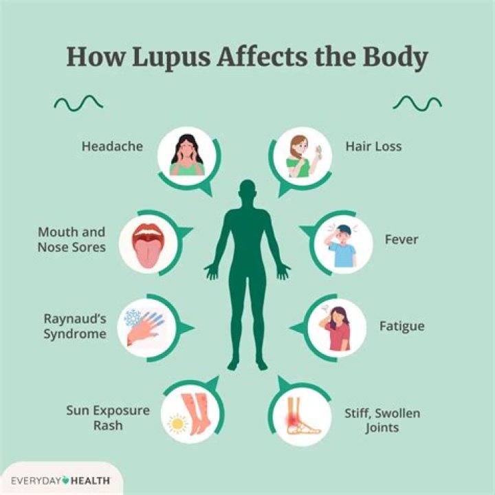 Can discoid lupus cause fatigue?