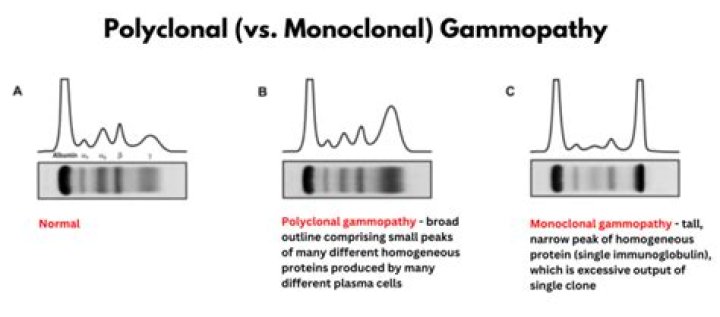 Can polyclonal gammopathy be cured?