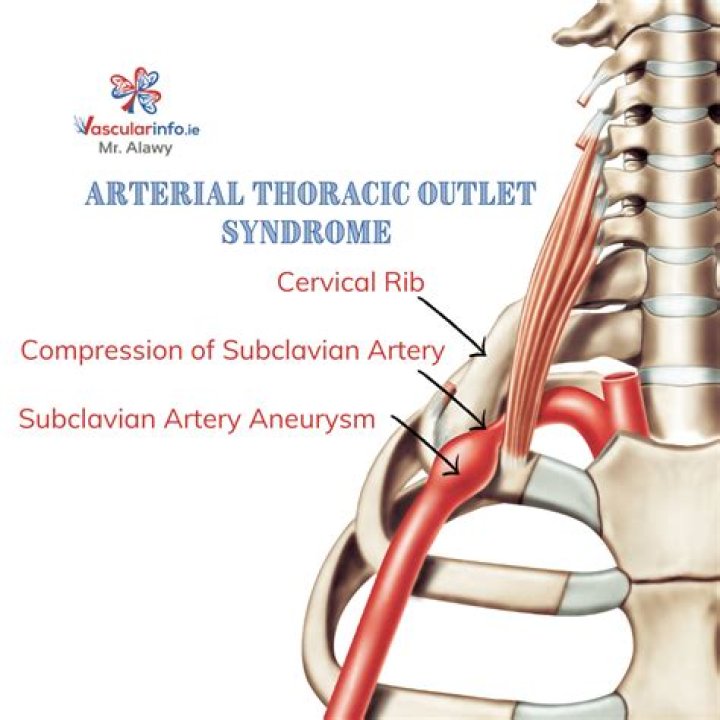Can subclavian steal cause headaches?