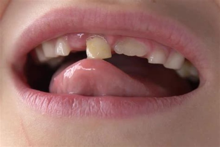 Can you stabilise a loose tooth?
