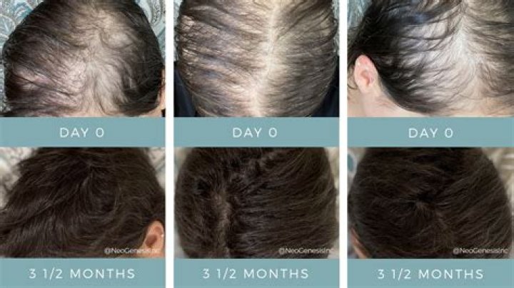 Can ziac cause hair loss?