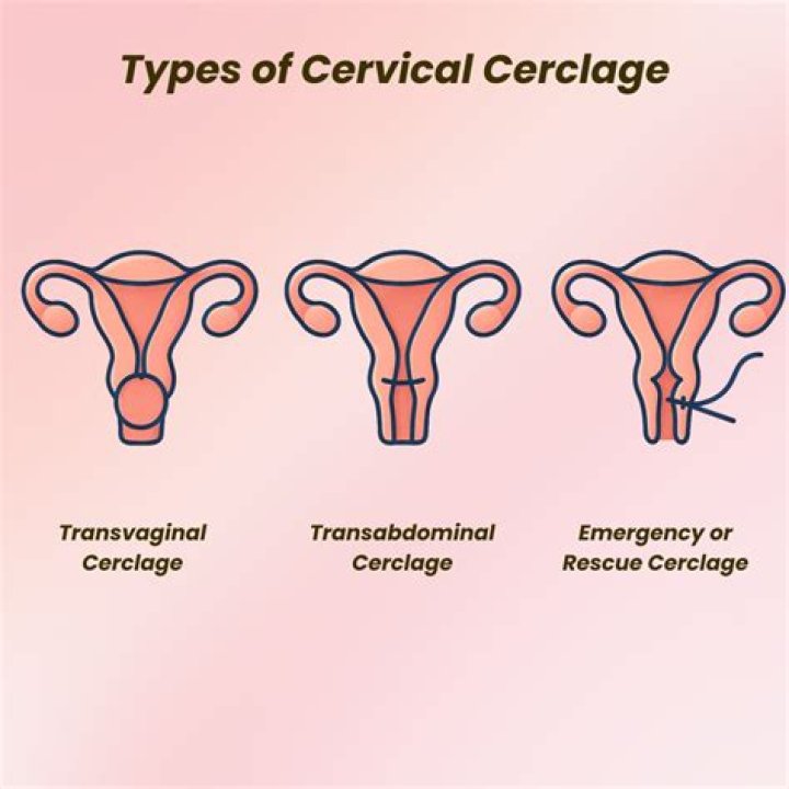 Do's and don'ts after cervical cerclage?