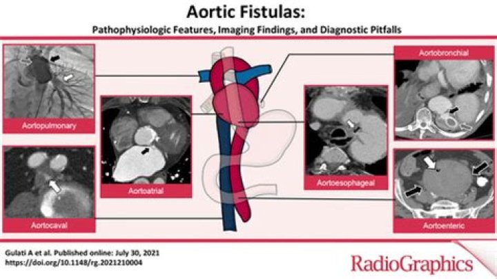 Do fistulas go away?