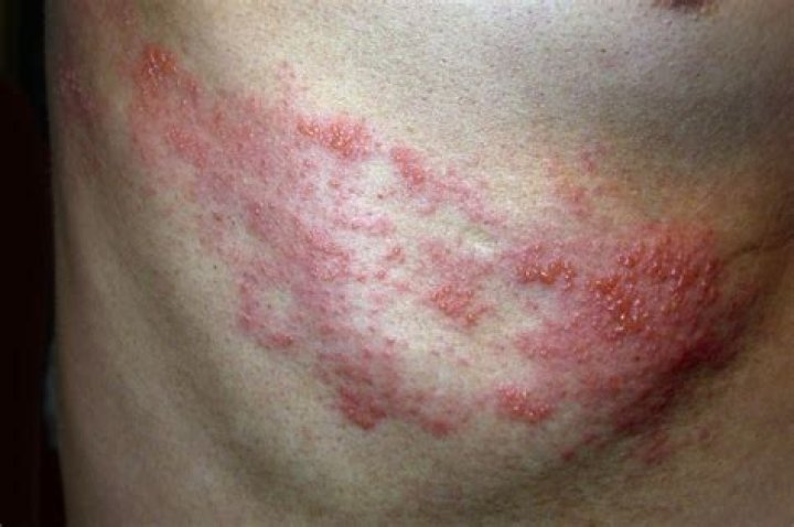 Do shingles blisters always burst?