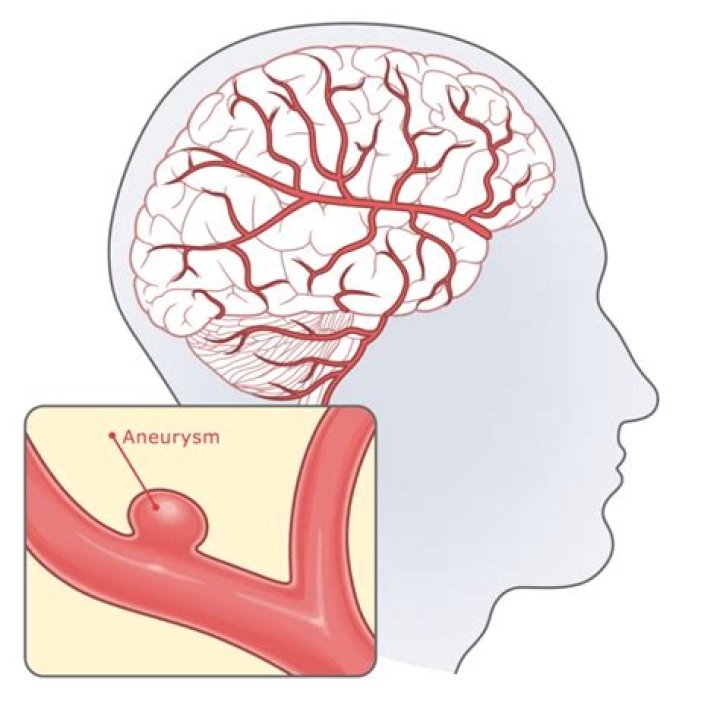 Does avm cause aneurysm?