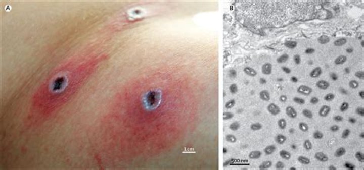 Does cowpox still exist?