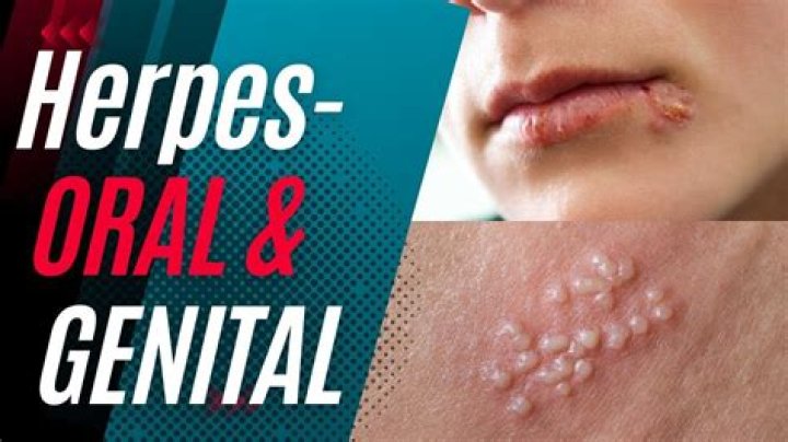Does genital herpes go away?