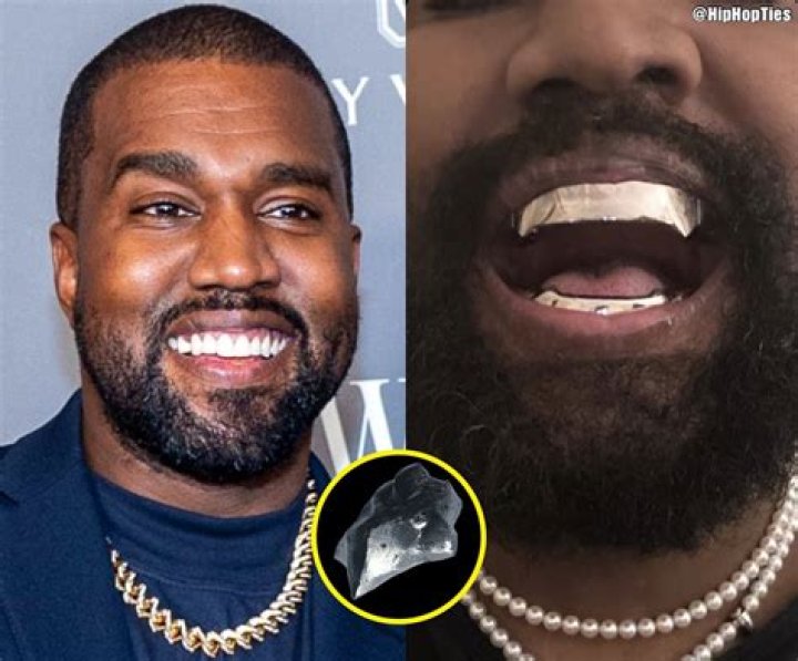 Does Kanye West Have Braces and Are His Bottom Teeth Grillz?