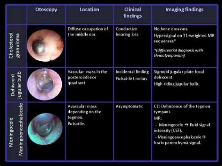 Does otosclerosis get worse?