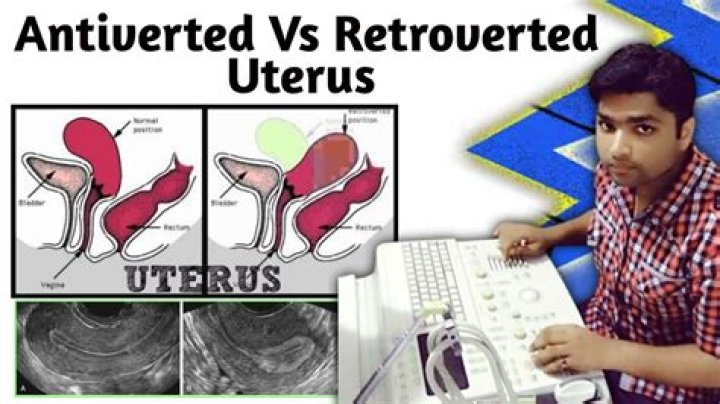 Does retroverted uterus affect pregnancy?