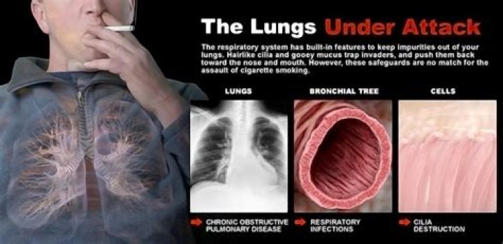 Does smoking paralyzes cilia?