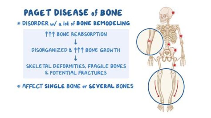 Has anyone had paget's disease?