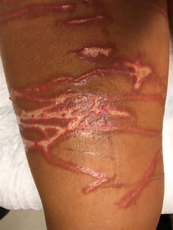 Has anyone survived a box jellyfish sting?