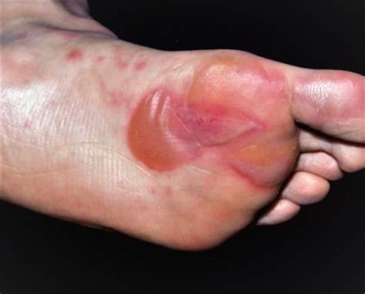 Has blisters on feet?