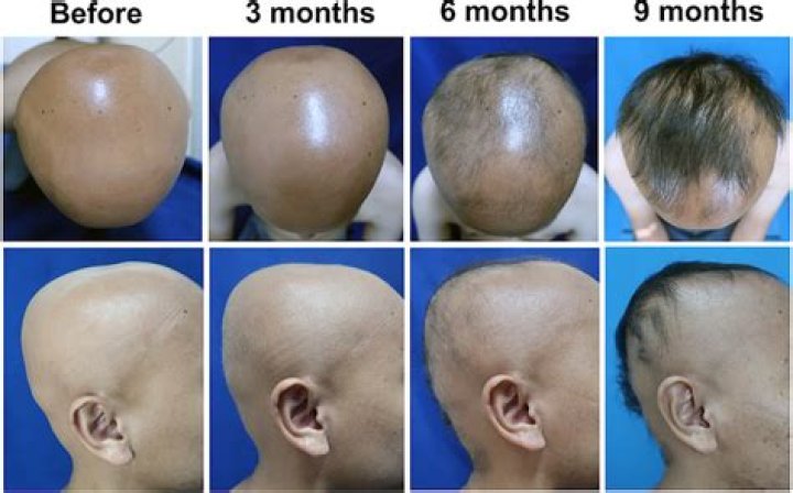 How do you get alopecia?
