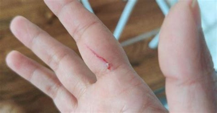 How does a cut heal faster?