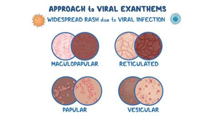 How long does papular urticaria last?