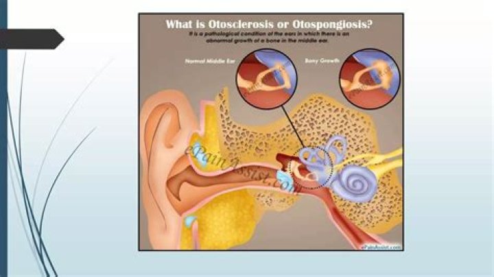 How quickly does otosclerosis progress?