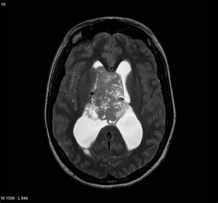 How rare is central neurocytoma?