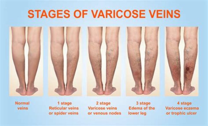 How varicose veins form?