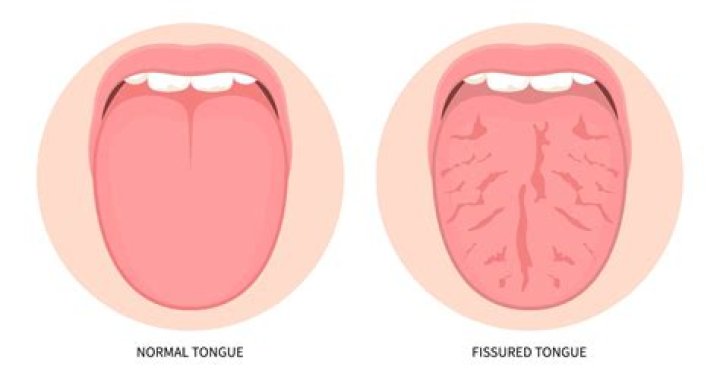 Is fissured tongue reversible?