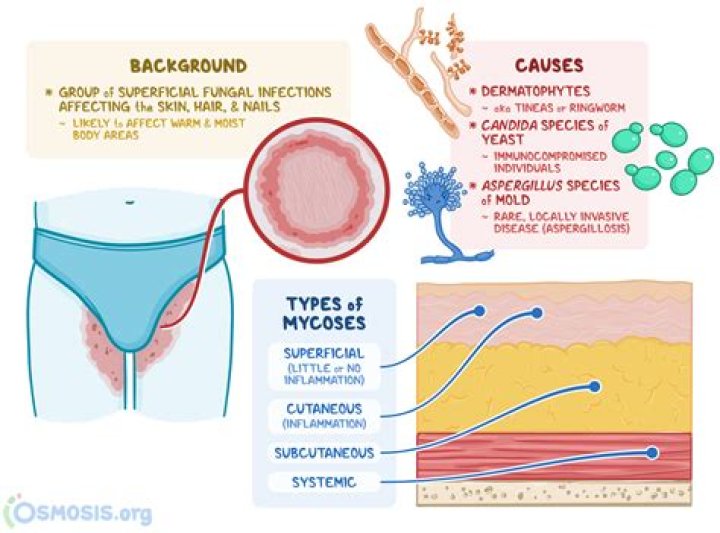 Is mycosis fungoides an autoimmune disease?