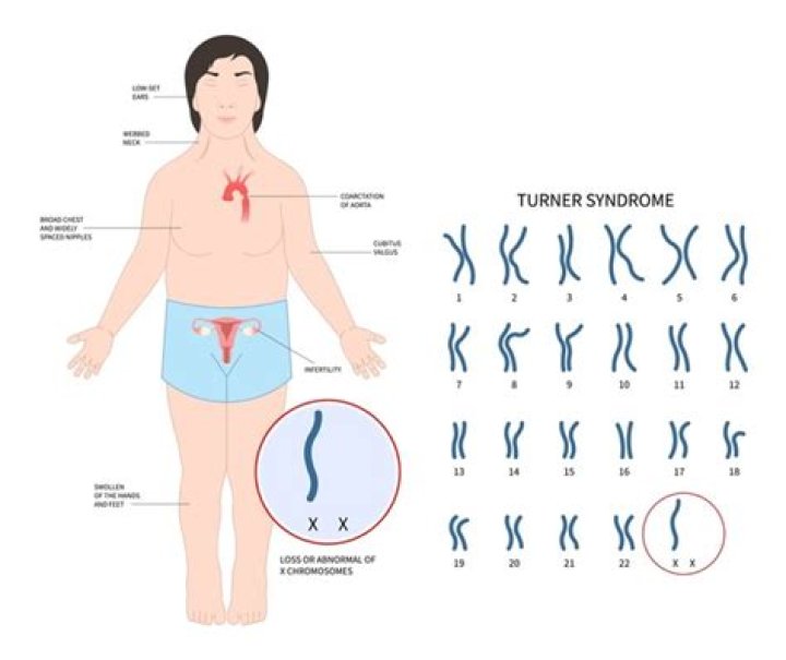 Is turner's syndrome intersex?