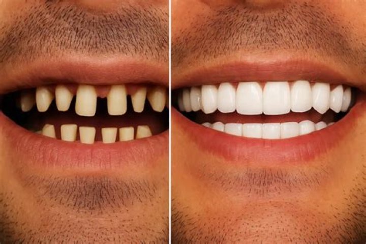 Matt Rife Teeth Before and After Veneers Photos Are Adorable