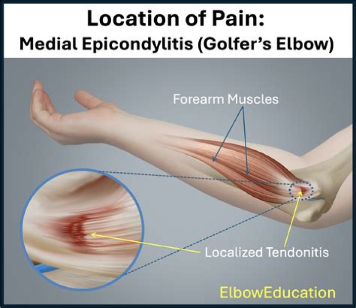 Should you massage lateral epicondylitis?