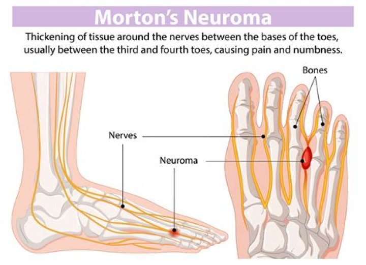 Was ist morton's neuroma?