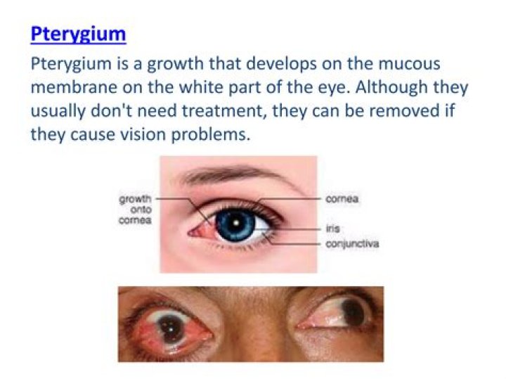 What can cause pterygium?