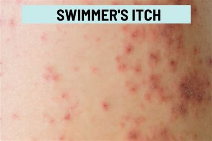 What causes itches after bathing?