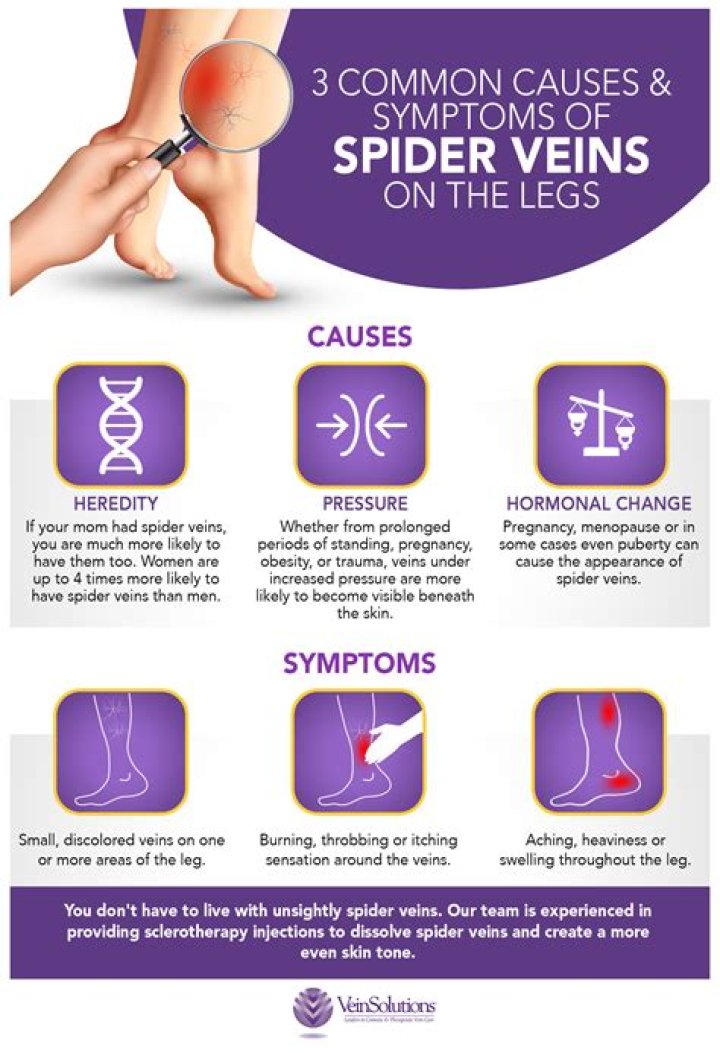 What causes spider veins?