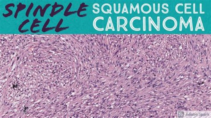 What causes spindle cell tumors?