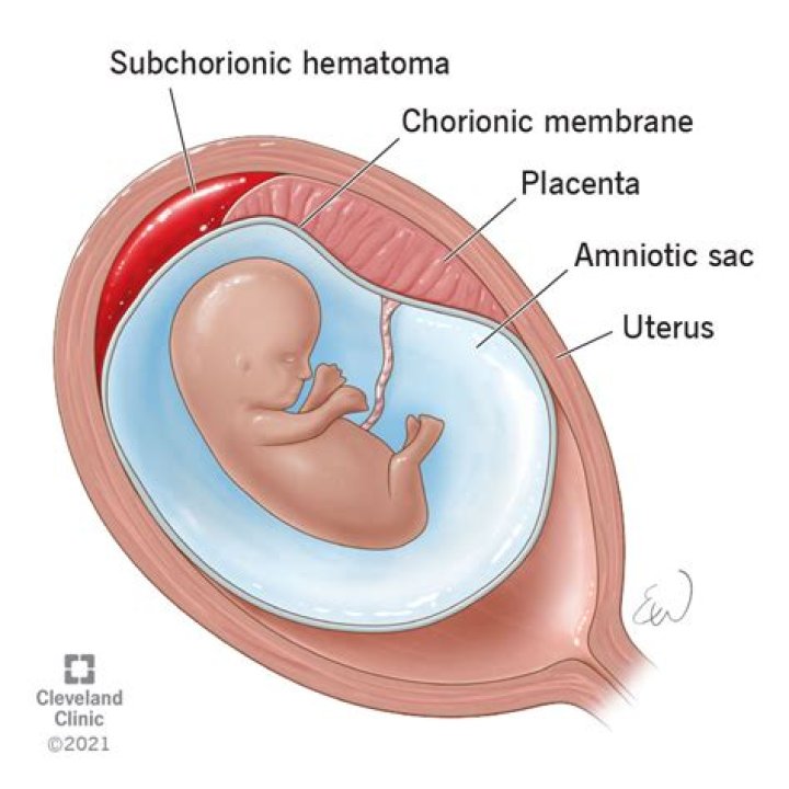 What irritates a subchorionic hematoma?