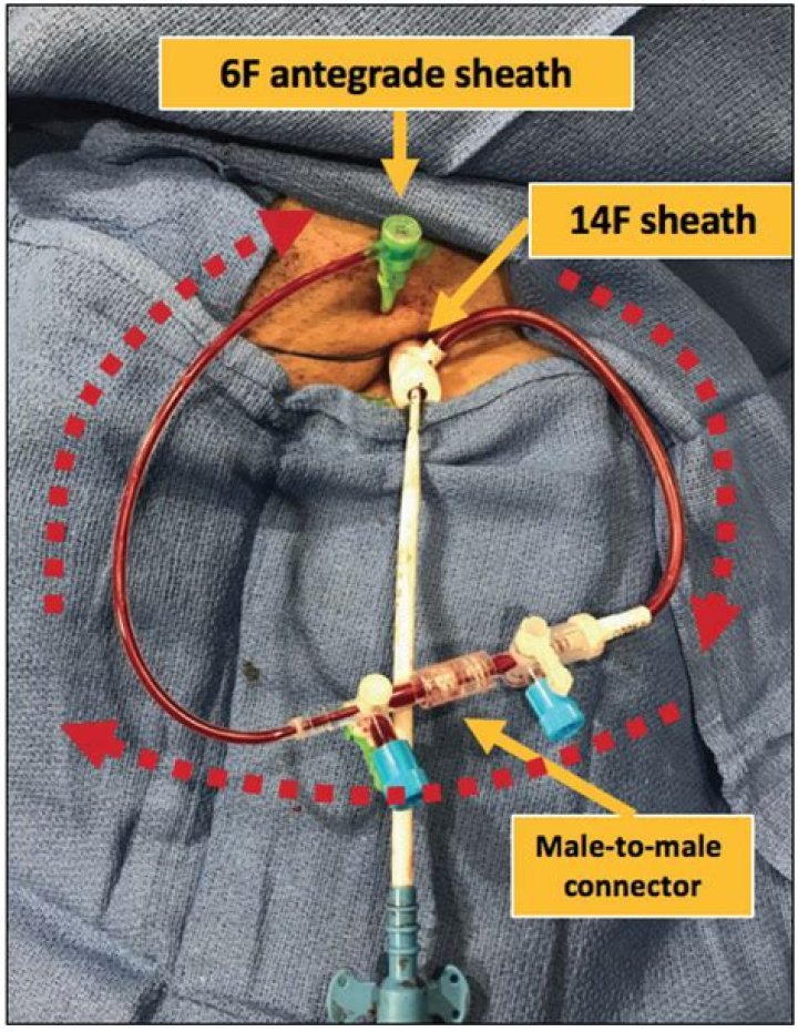 What is a cardiac sheath?