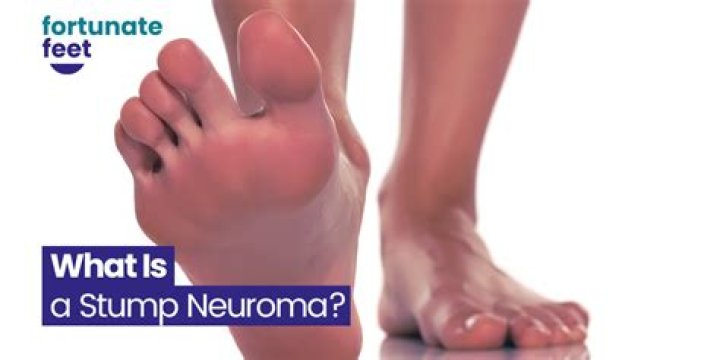 What is a stump neuroma?