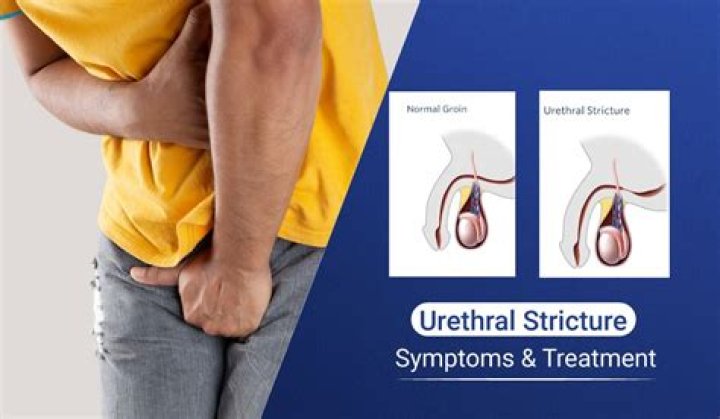 What is a urethral stricture?