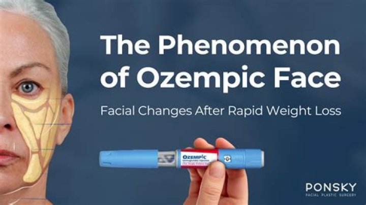 
What is Ozempic face? Side effects of popular weight loss drug explored 