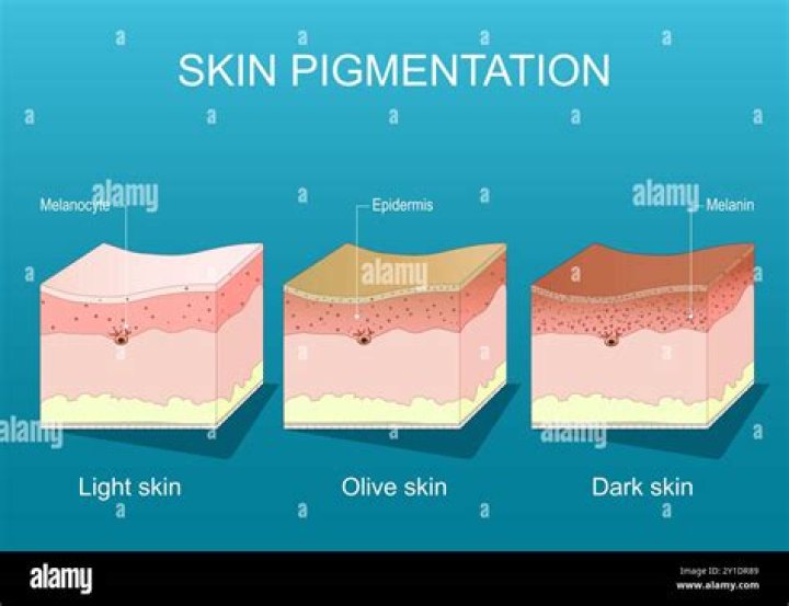 What is the medical definition for melanoderma?