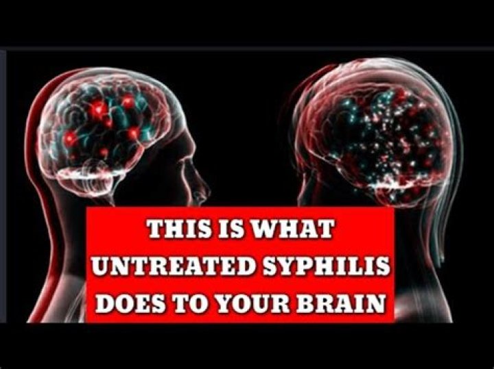 What syphilis does to the brain?