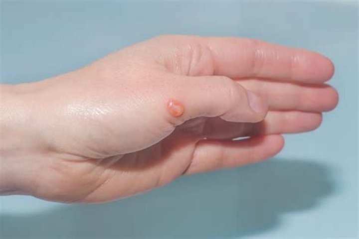 When blisters pop does it hurt?