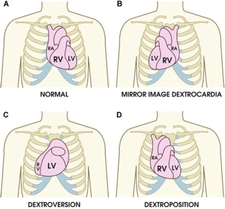 When does malrotation occur?